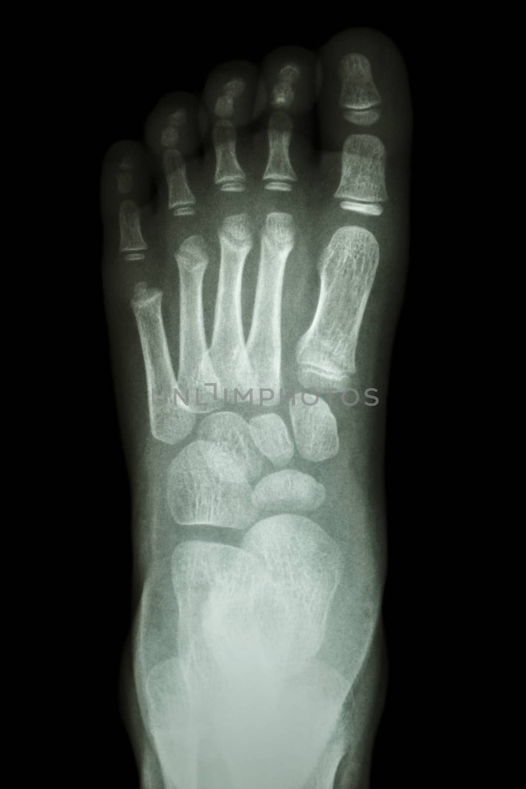 x-ray foot AP : show normal child's foot by stockdevil