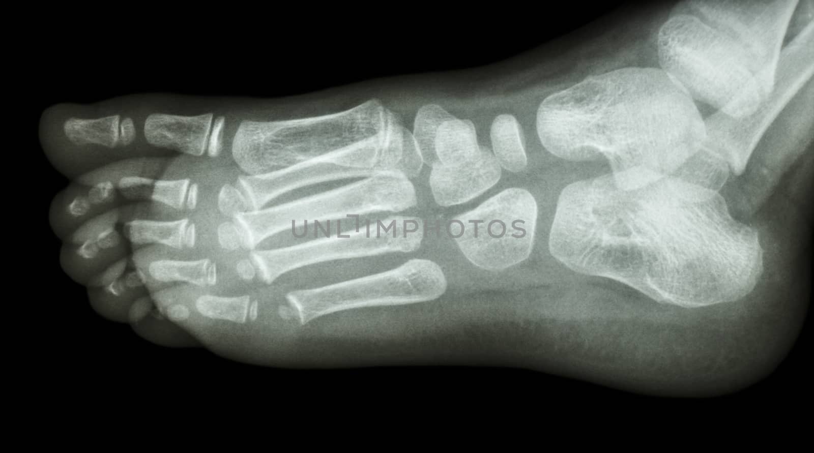 x-ray foot lateral : show normal child's foot by stockdevil