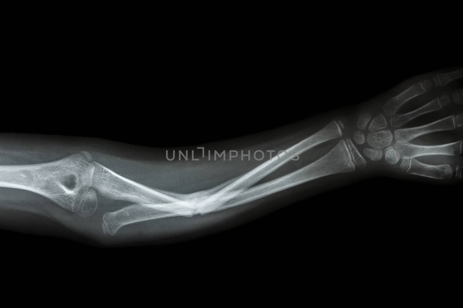 film x-ray forearm AP : show fracture shaft of ulnar(forearm's bone)