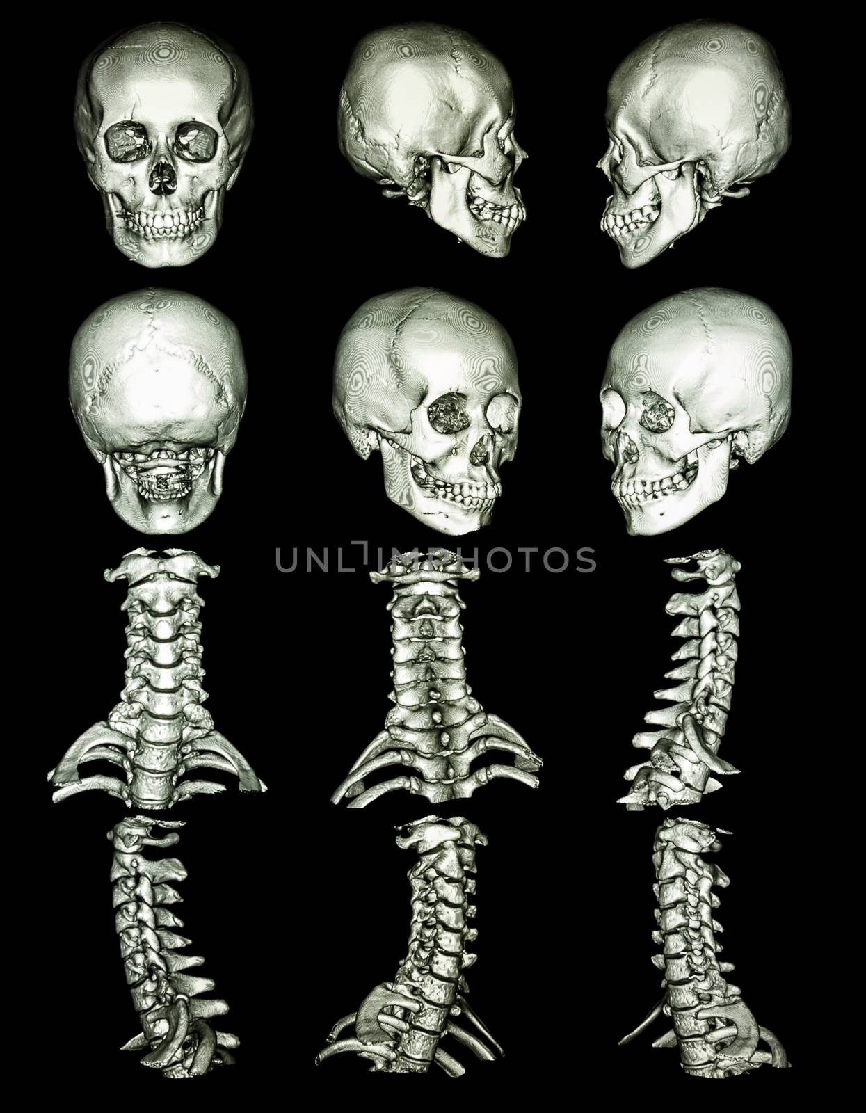 CT scan (Computed tomography) with 3D graphic show normal human's skull and cervial spine