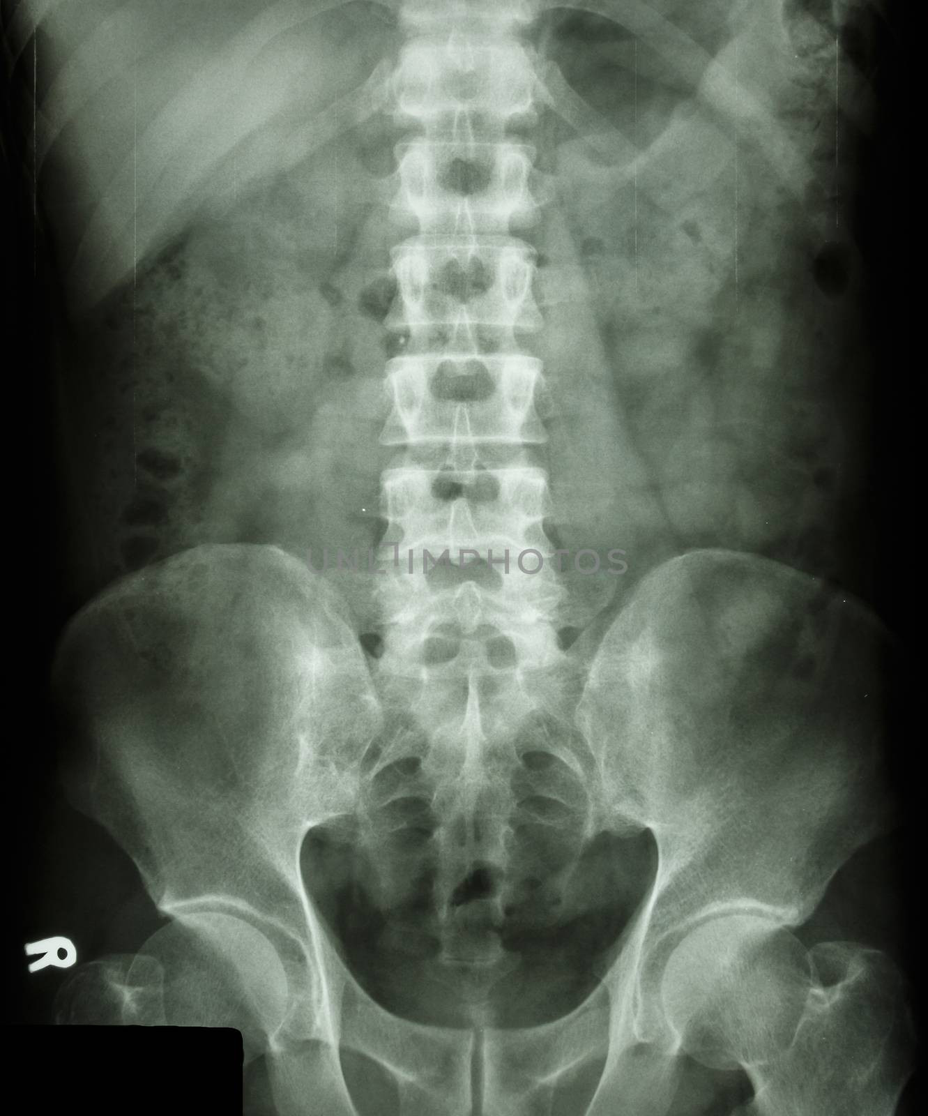 normal human's lumbosacral spine by stockdevil