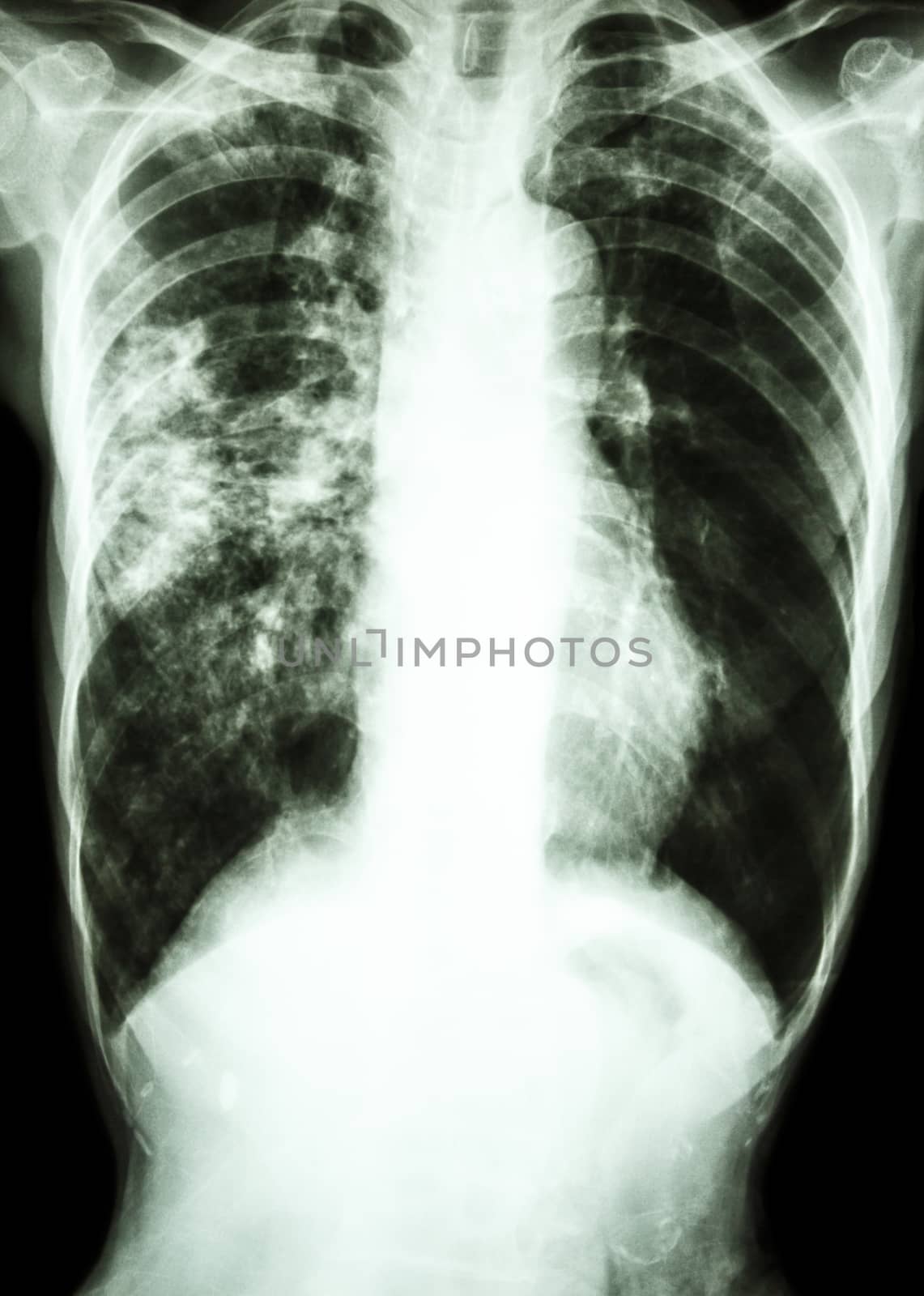 film chest x-ray show alveolar infiltrate at right lung due to Mycobacterium tuberculosis infection (Pulmonary Tuberculosis)