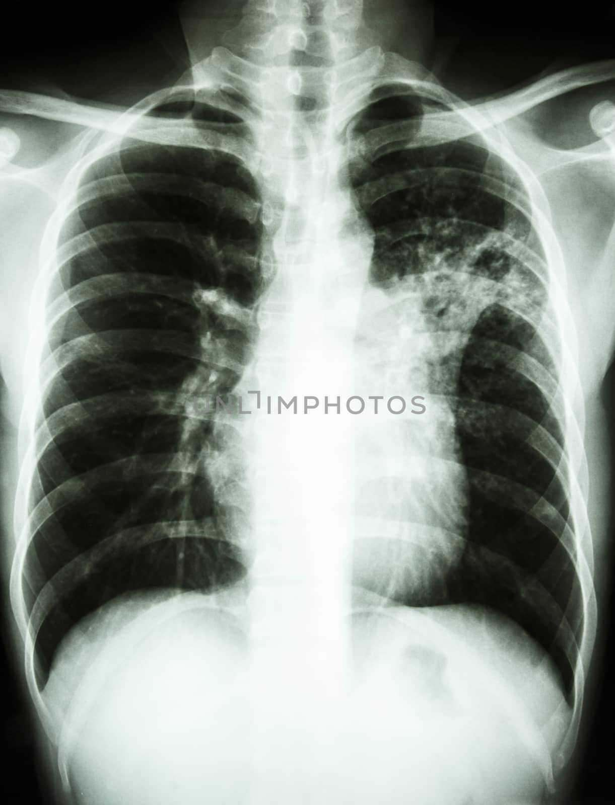 Mycobacterium tuberculosis infection (Pulmonary Tuberculosis) by stockdevil