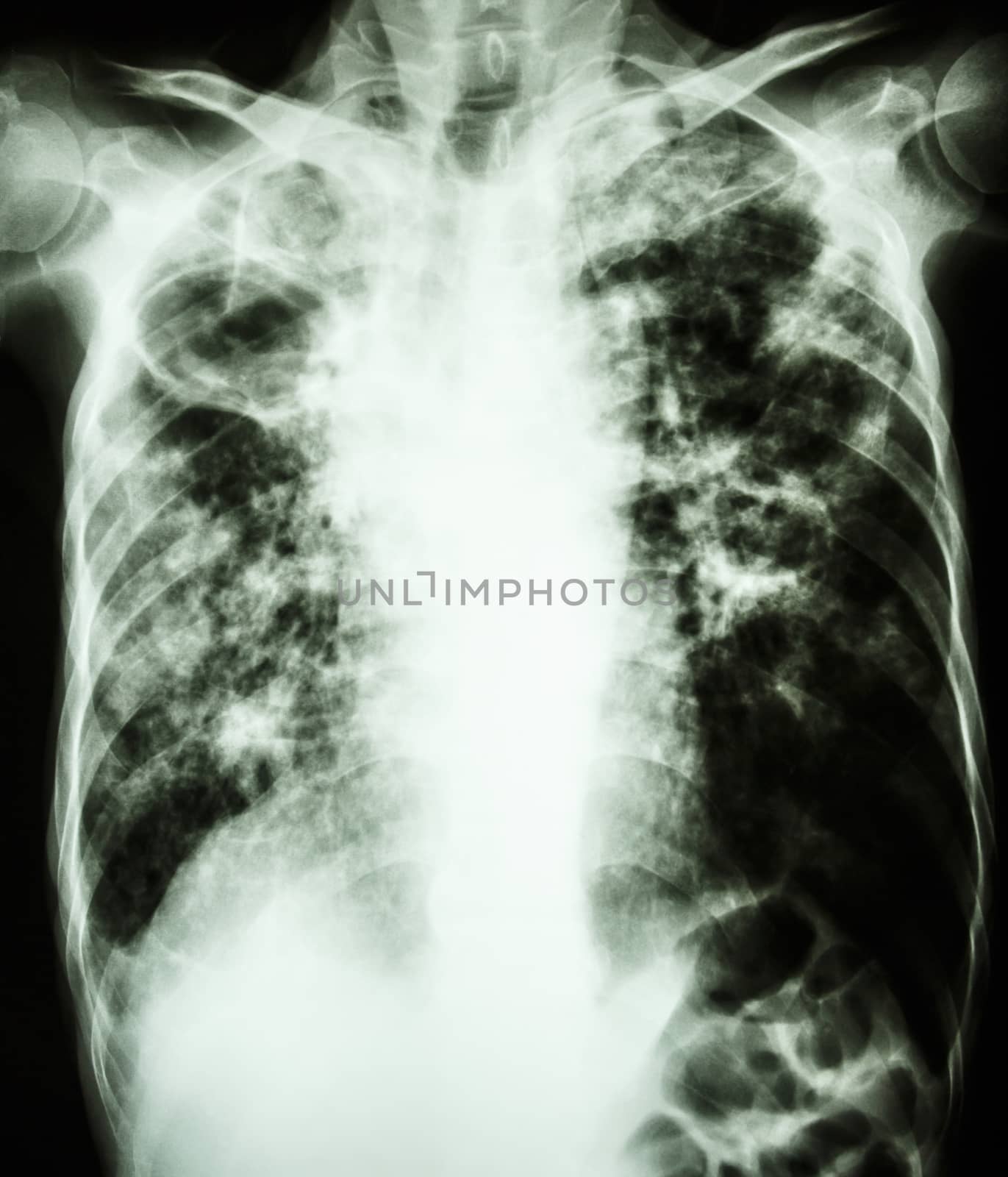 Mycobacterium tuberculosis infection (Pulmonary Tuberculosis) by stockdevil