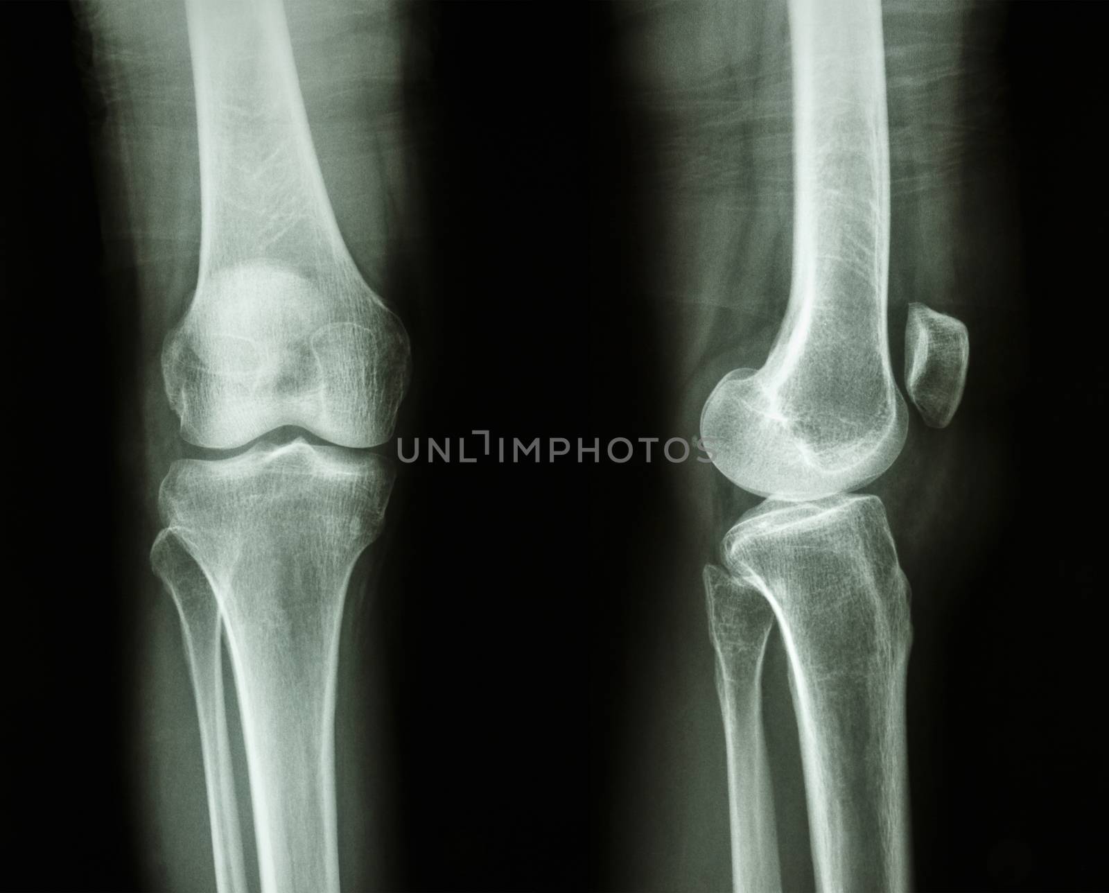 Film x-ray knee AP/lateral : show normal human's knee