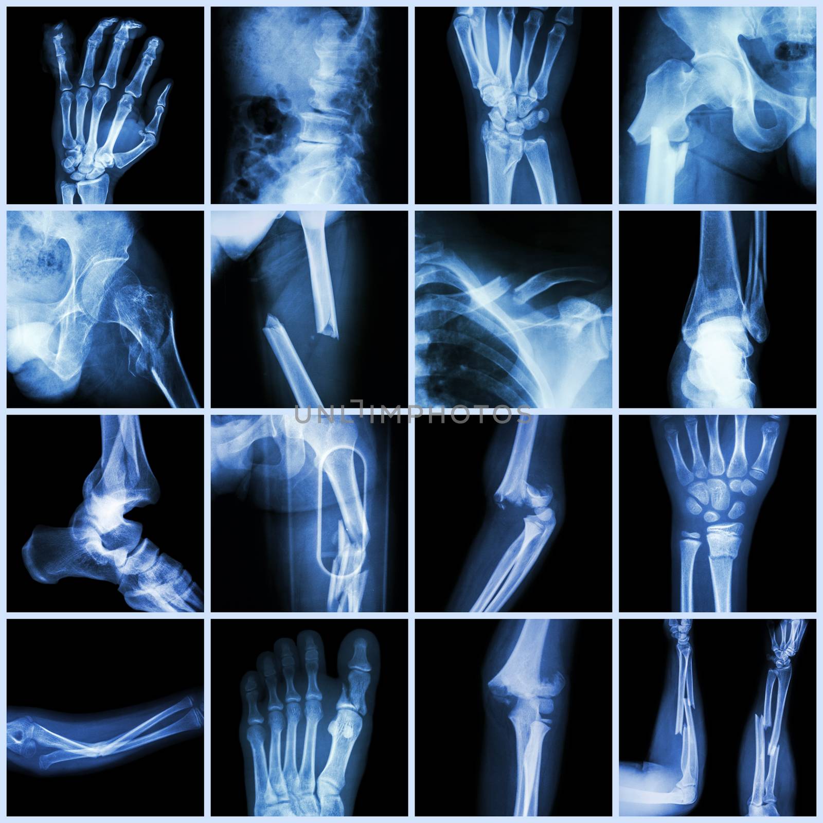 Collection X-ray multiple bone fracture (finger,spine,wrist,hip,leg,clavicle,ankle,elbow,arm,foot) by stockdevil