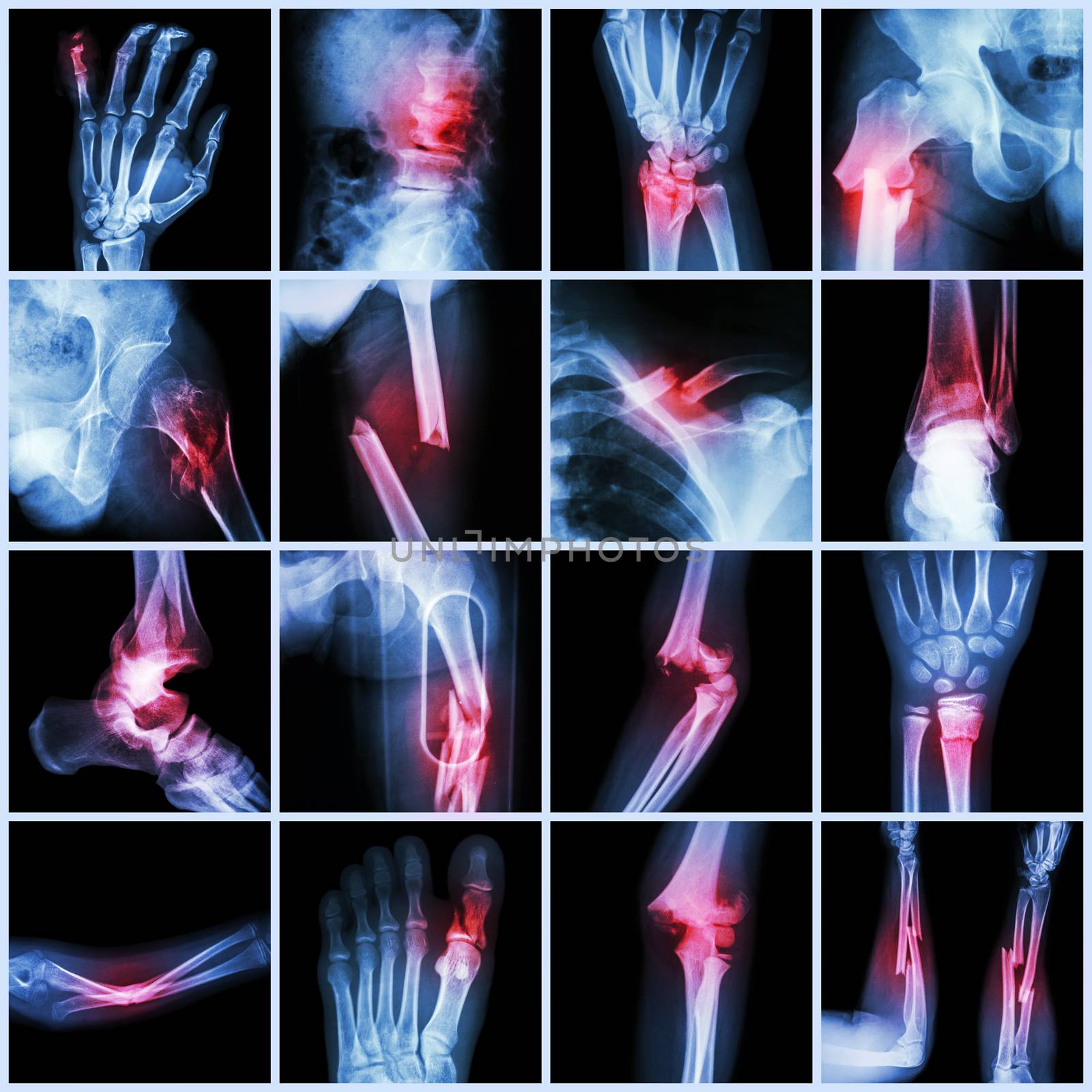 Collection X-ray multiple bone fracture (finger,spine,wrist,hip,leg,clavicle,ankle,elbow,arm,foot) by stockdevil