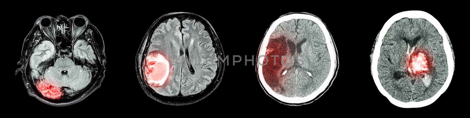 Collection CT scan of brain and multiple disease (Left to Right : Normal brain,Brain tumor,Cerebral infarction,Intracerebral hemorrhage) by stockdevil