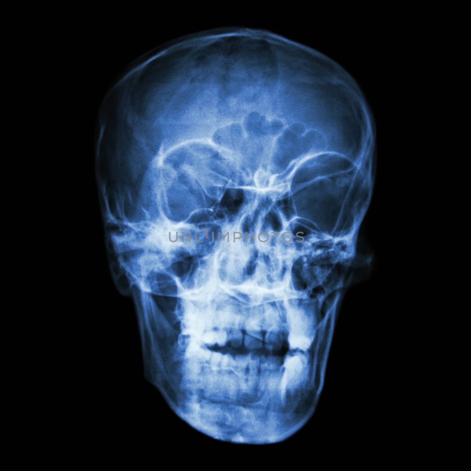 film x-ray asian people's skull (Thai people)