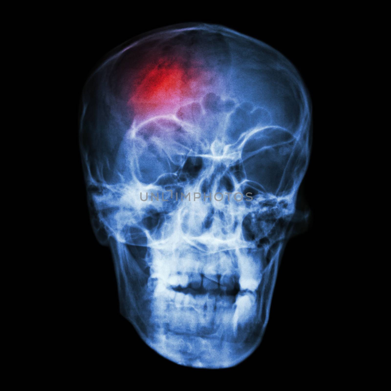 " Stroke (cerebrovascular accident) " X-ray side of asian skull by stockdevil