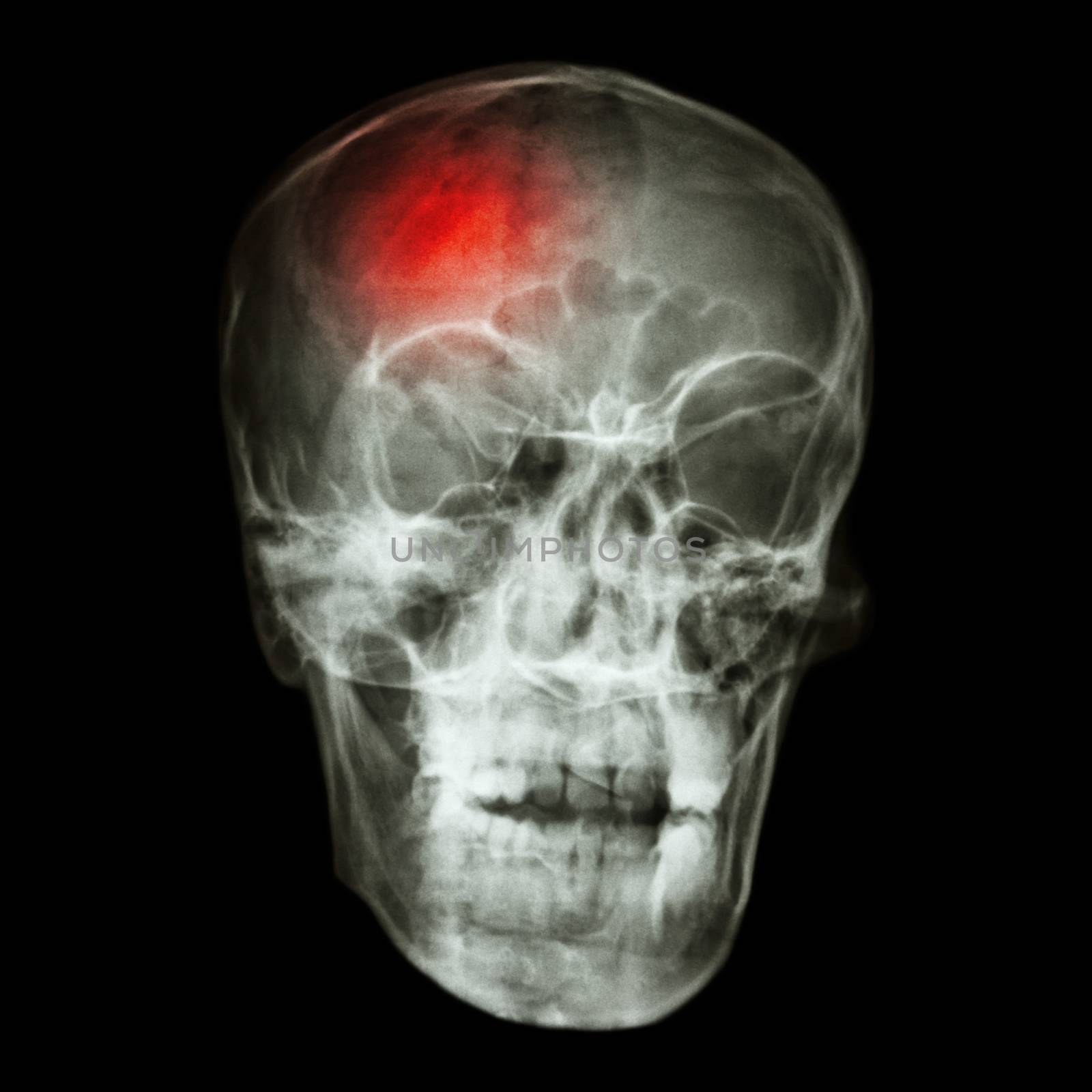 " Stroke (cerebrovascular accident) " X-ray side of asian skull by stockdevil