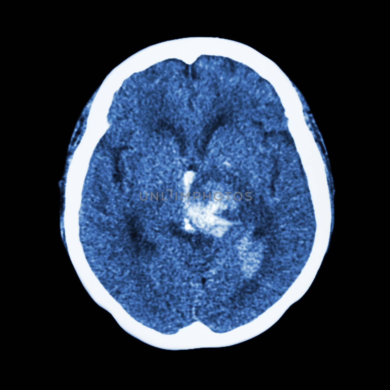 CT scan of brain : show hemorrhagic stroke by stockdevil