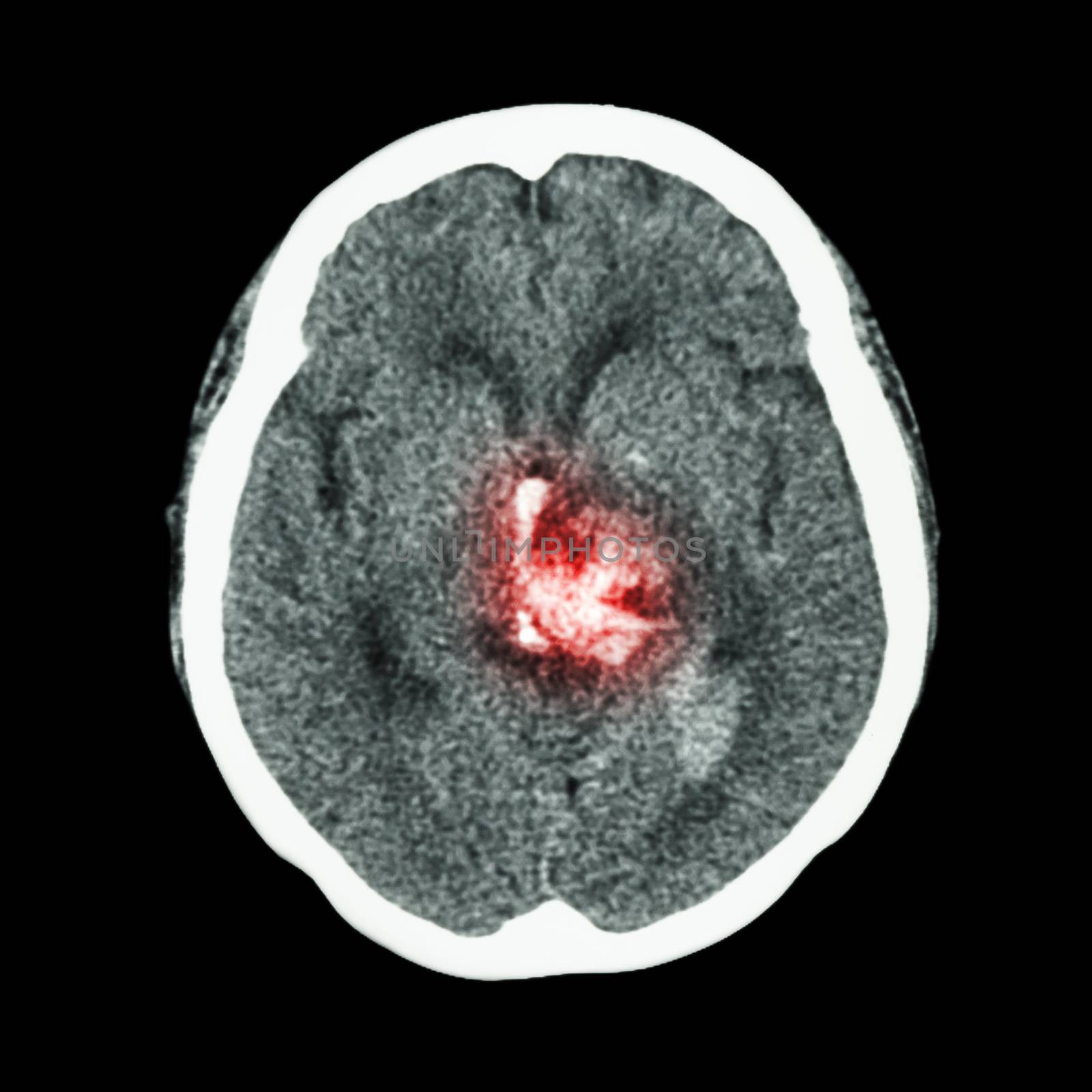 CT scan of brain : show hemorrhagic stroke by stockdevil