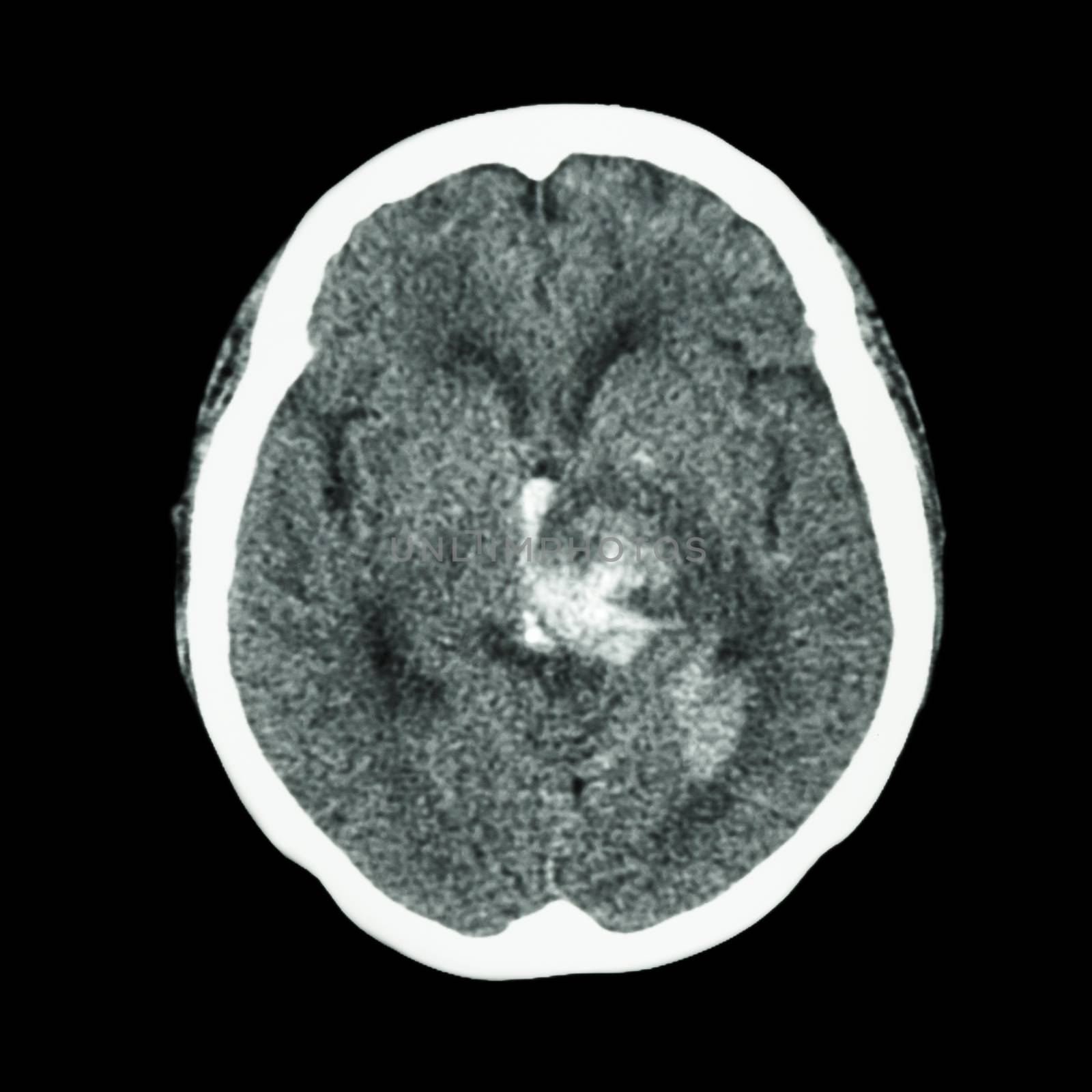 CT scan of brain : show hemorrhagic stroke by stockdevil