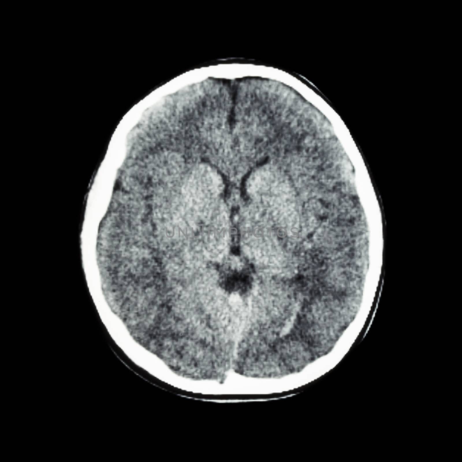normal CT scan of brain (Computed tomography) by stockdevil