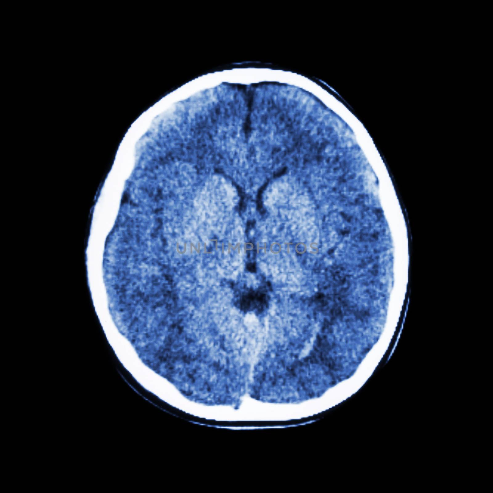 normal CT scan of brain (Computed tomography)