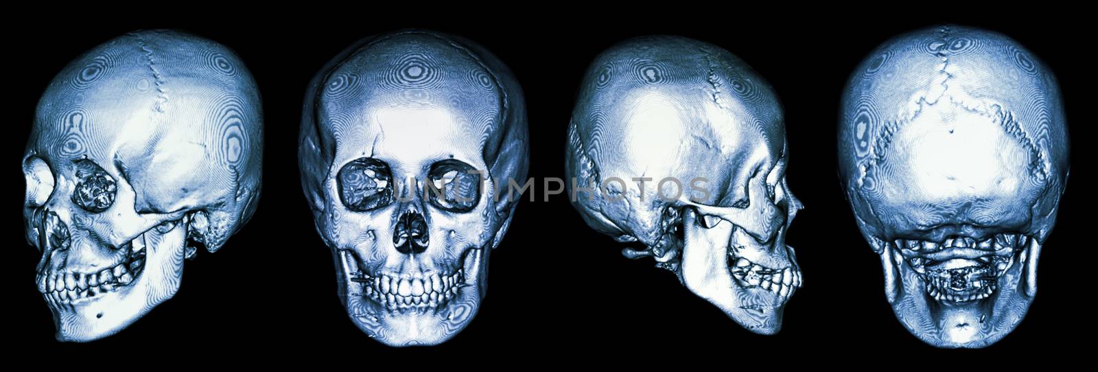 CT scan of human skull and 3D by stockdevil