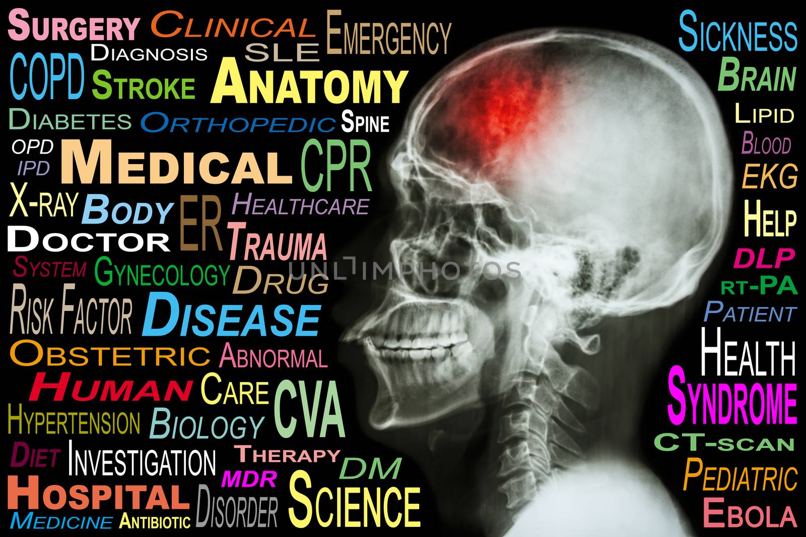 X-ray skull and "Stroke" and Medical word cloud by stockdevil