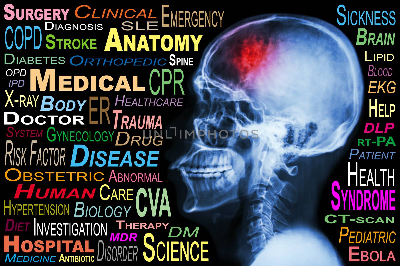 X-ray skull and "Stroke" and Medical word cloud