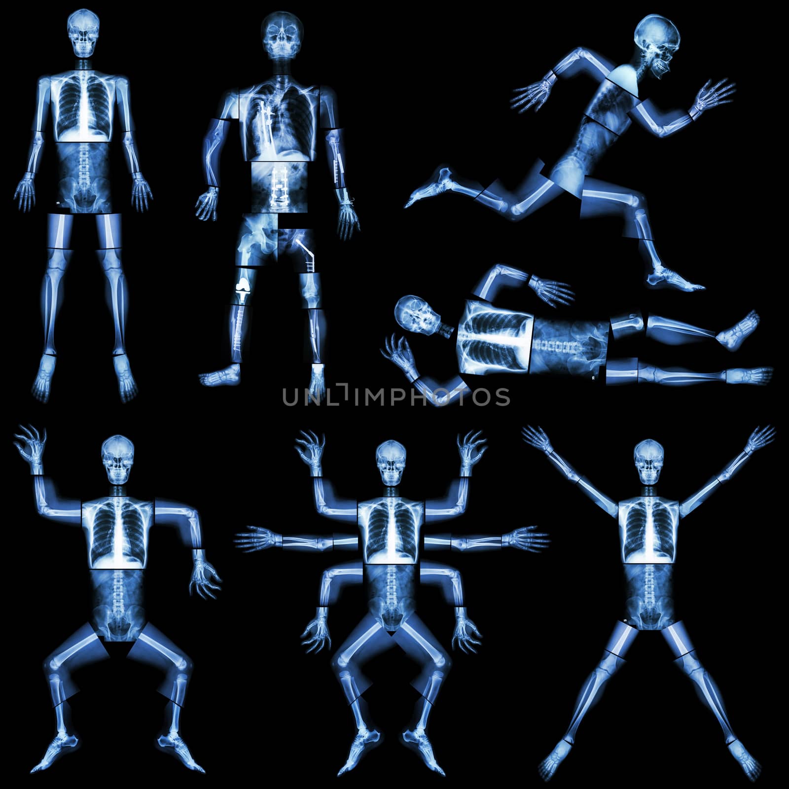 Collection of human skeleton (X-ray whole body : skull head face neck spine shoulder arm forearm elbow wrist hand finger thorax lung heart abdomen pelvis leg knee joint thigh foot ankle heel )