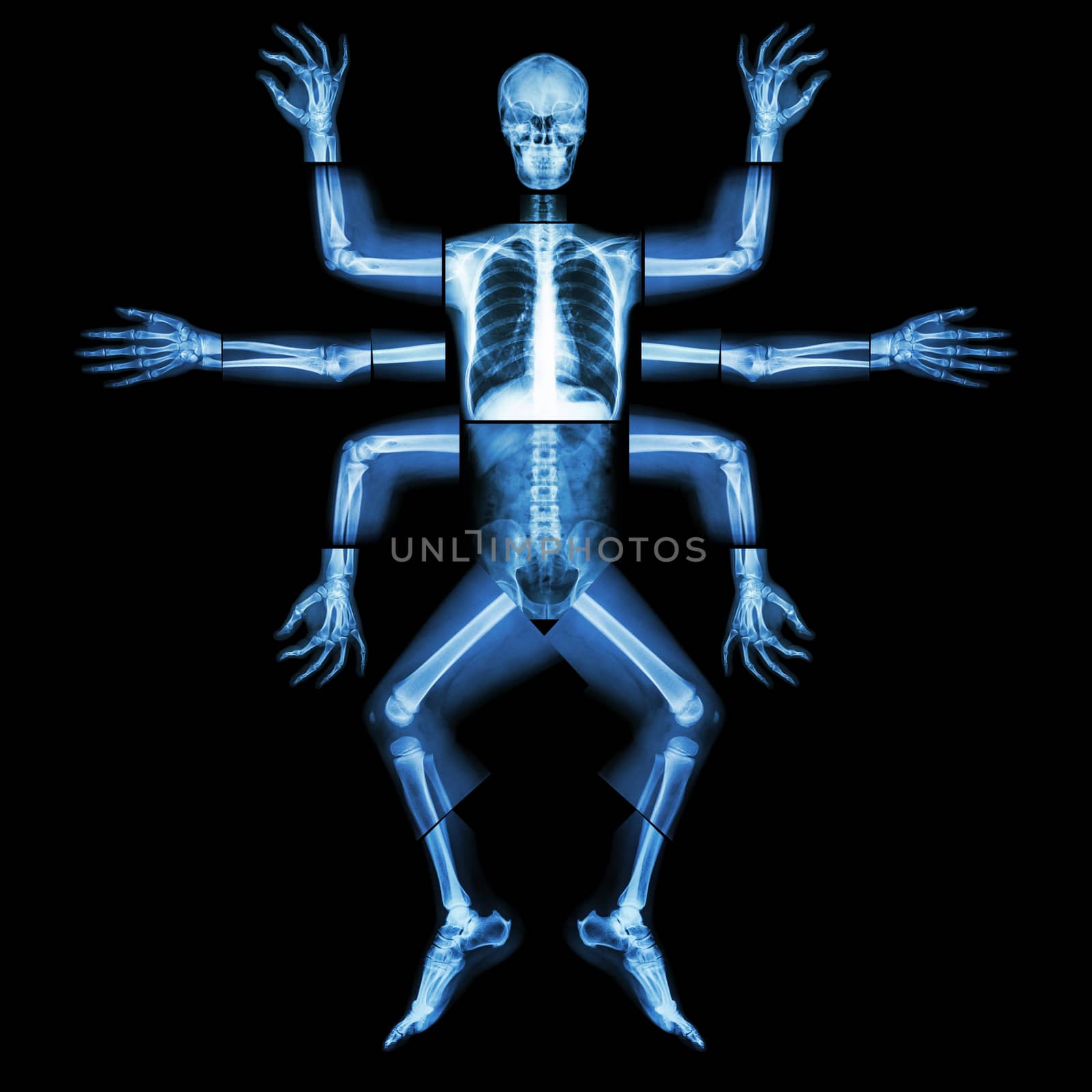 Monster have many arm. (X-ray whole body : head neck shoulder arm forearm elbow wrist hand digit thorax rib lung heart spine abdomen pelvic hip thigh leg knee ankle heel foot) by stockdevil