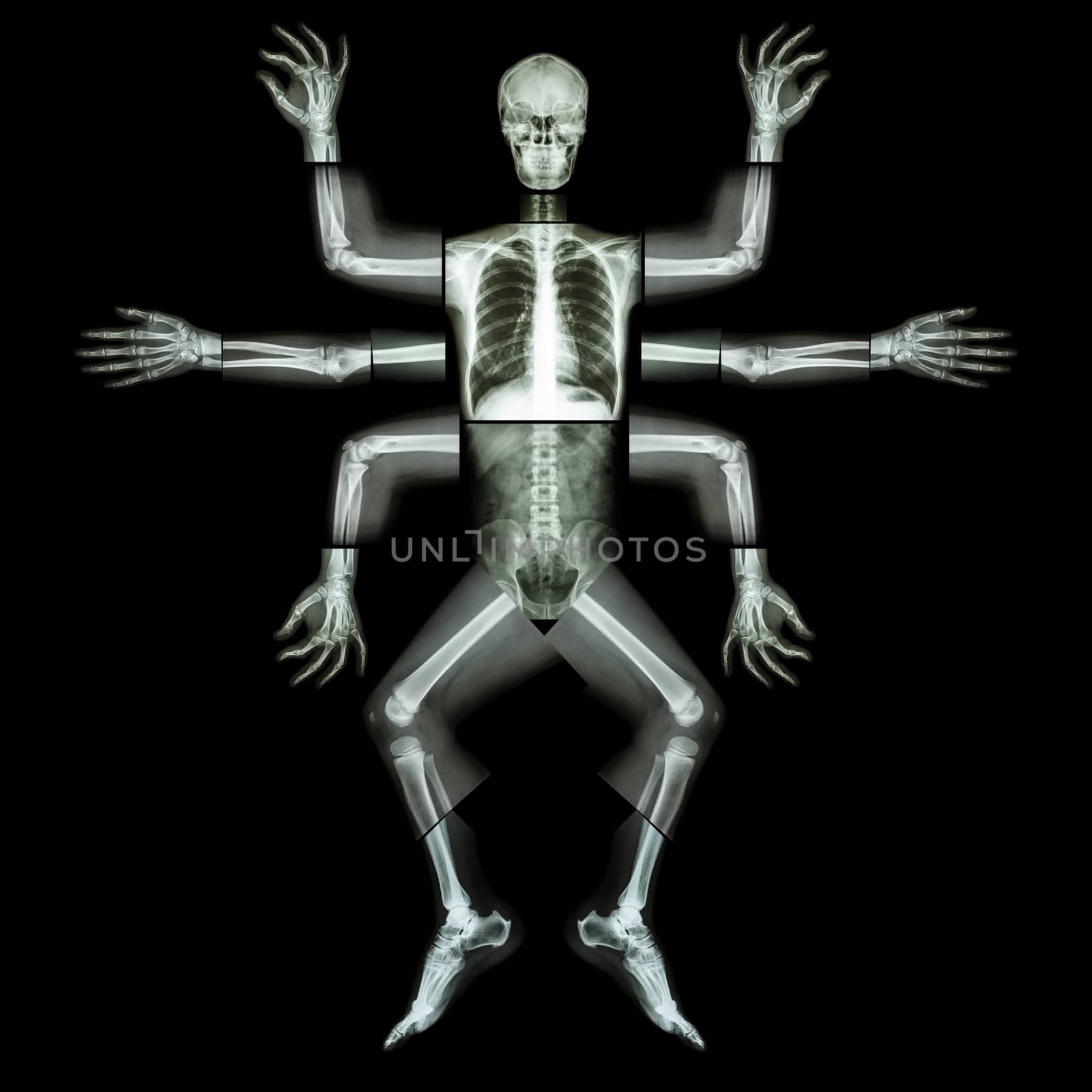 Monster have many arm. (X-ray whole body : head neck shoulder arm forearm elbow wrist hand digit thorax rib lung heart spine abdomen pelvic hip thigh leg knee ankle heel foot)