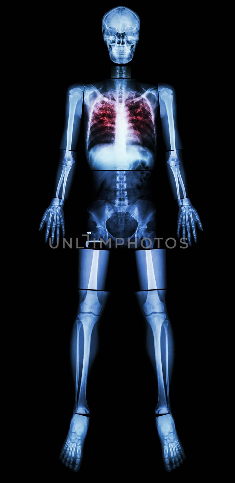 Pulmonary Tuberculosis(TB)(X-ray whole body : head skull neck spine shoulder arm elbow forearm wrist hand finger thorax chest heart lung rib back abdomen pelvis hip thigh knee leg ankle foot heel toe)