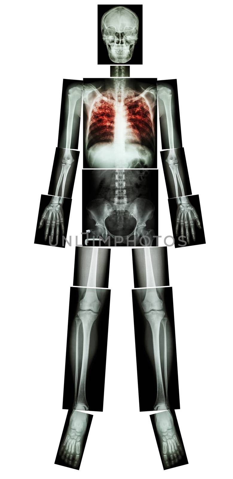 Pulmonary Tuberculosis(TB)(X-ray whole body : head skull neck spine shoulder arm elbow forearm wrist hand finger thorax chest heart lung rib back abdomen pelvis hip thigh knee leg ankle foot heel toe)