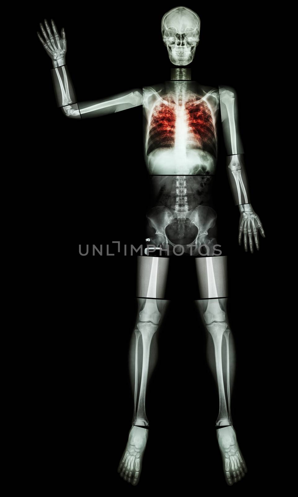 Stop TB(Tuberculosis) (Human bone raise hand) (Whole body :head skull neck spine shoulder arm elbow forearm wrist hand finger thorax chest heart rib back abdomen pelvis hip thigh knee leg ankle foot)