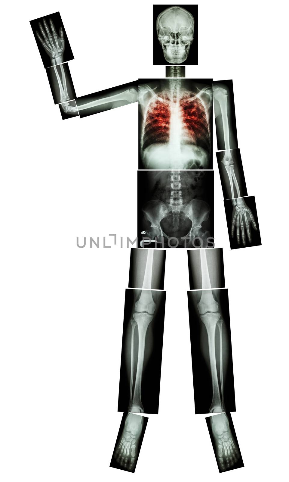 Stop TB(Tuberculosis) (Human bone raise hand) (Whole body :head skull neck spine shoulder arm elbow forearm wrist hand finger thorax chest heart rib back abdomen pelvis hip thigh knee leg ankle foot)