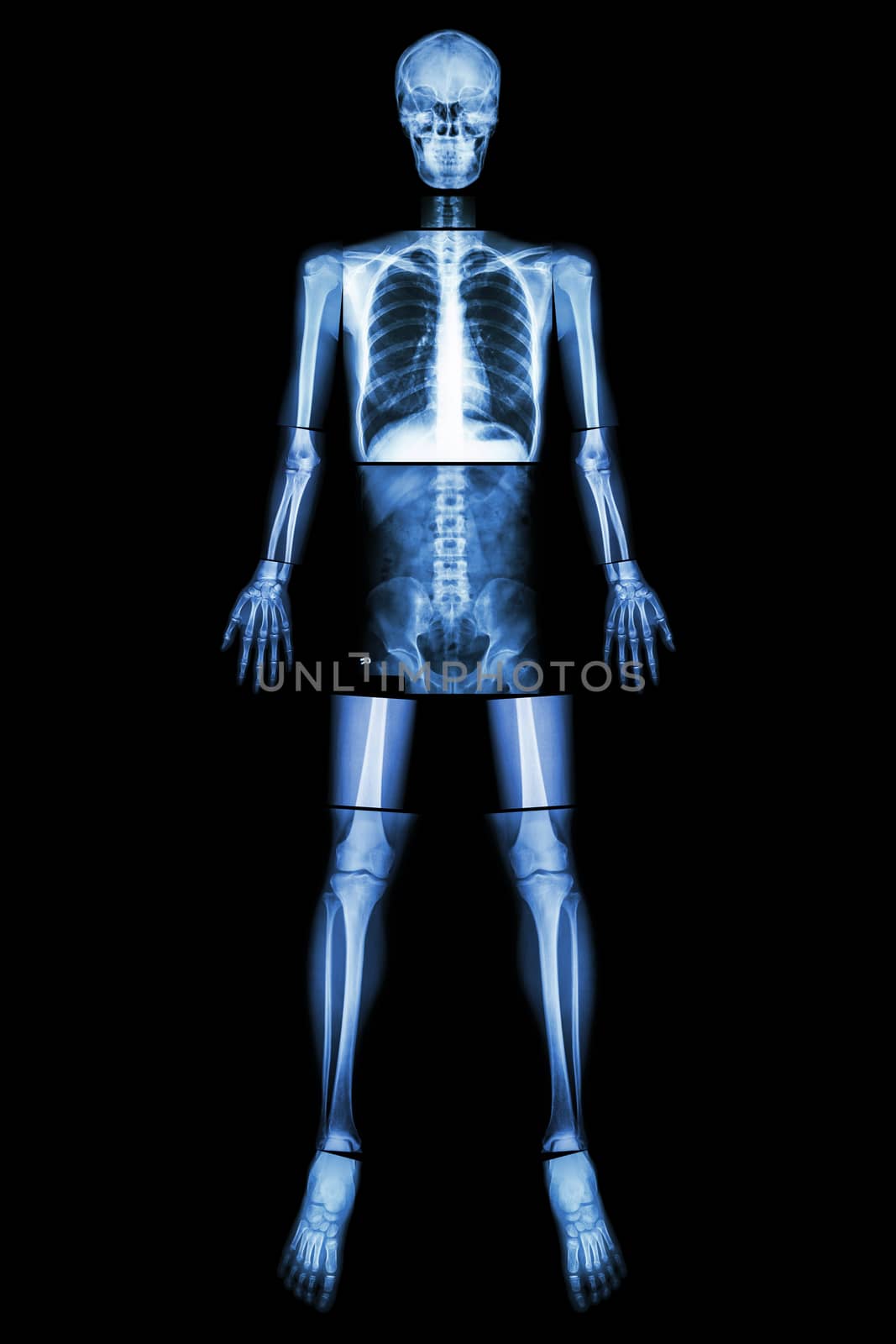 Anatomical Position. (X-ray whole body : head ,neck ,thorax ,heart ,lung ,rib ,shoulder ,scapula ,arm ,forearm ,elbow ,wrist ,hand ,digit ,abdomen ,hip ,pelvic ,leg ,thigh ,knee ,ankle ,heel ,foot )