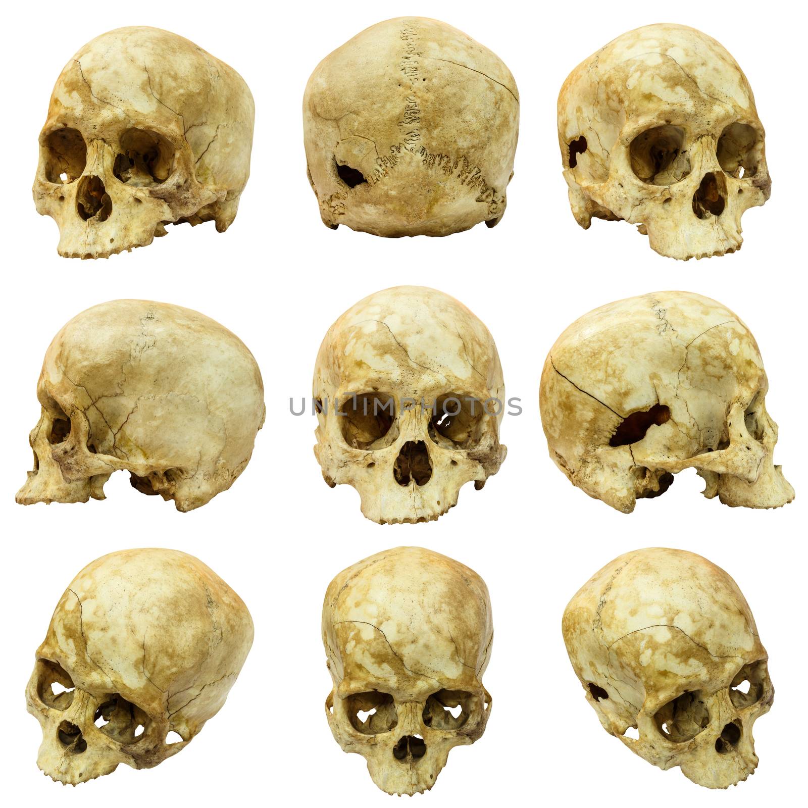 Collection of human skull (Mongoloid) and broken skull by stockdevil