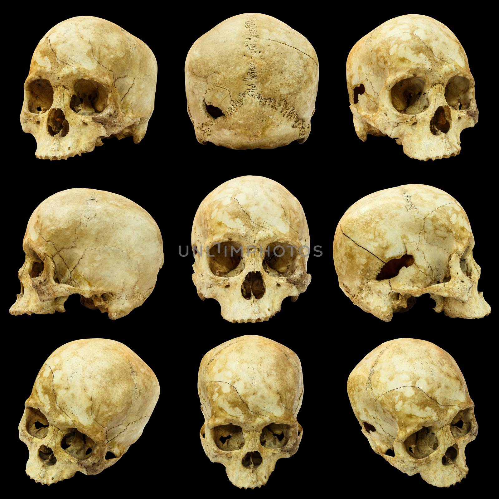 Collection of human skull (Mongoloid) and broken skull by stockdevil