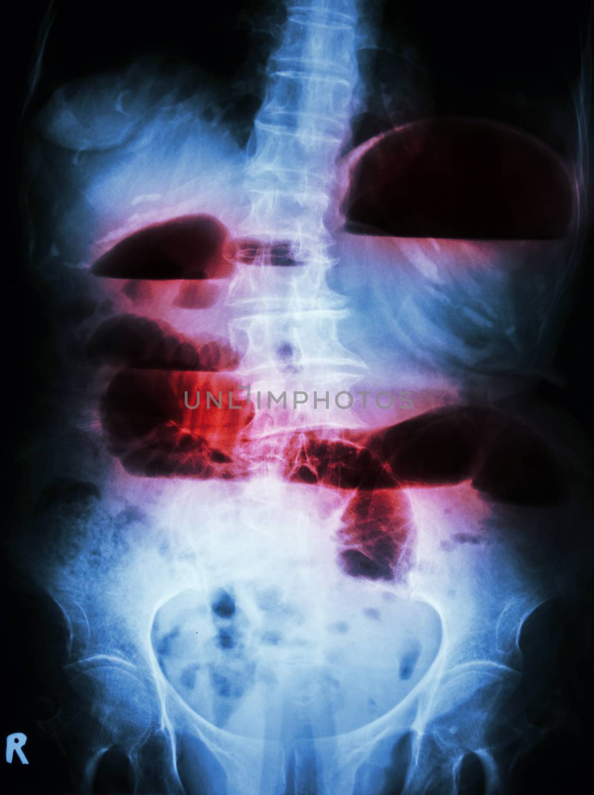 Film X-ray abdomen upright show small bowel dilated and air-fluid level in small bowel due to small bowel obstruction