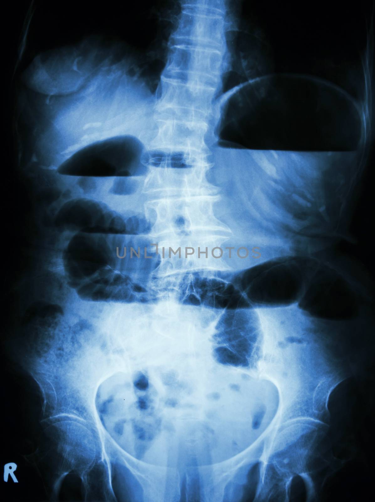 Small bowel obstruction. Film X-ray abdomen upright : show small bowel dilated and air-fluid level in small bowel due to small bowel obstruction by stockdevil