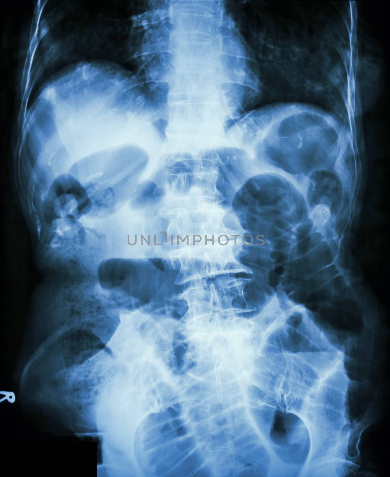 Small bowel obstruction. Film X-ray abdomen supine : show small bowel dilated due to small bowel obstruction by stockdevil