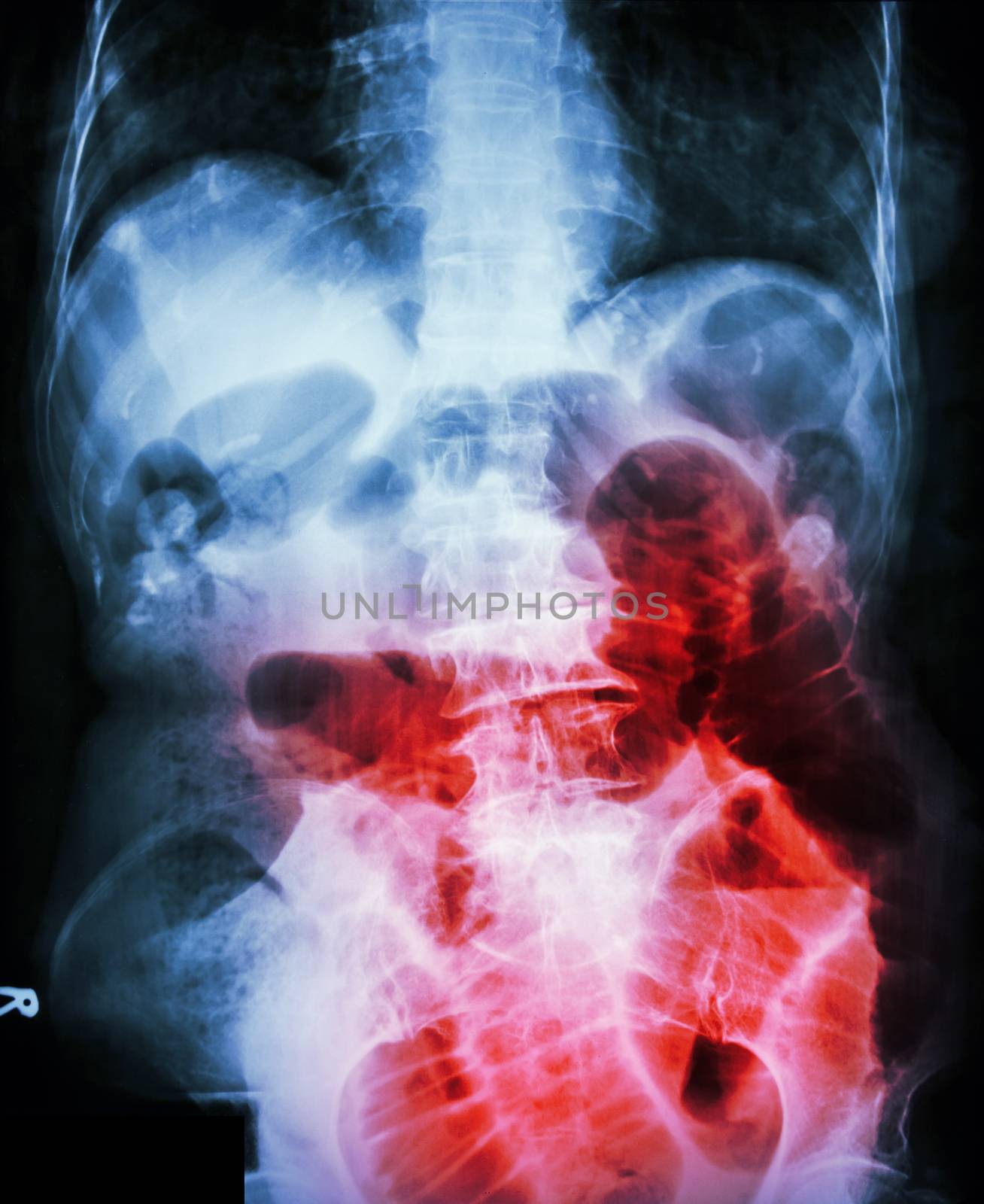 Small bowel obstruction. Film X-ray abdomen supine : show small bowel dilated due to small bowel obstruction by stockdevil