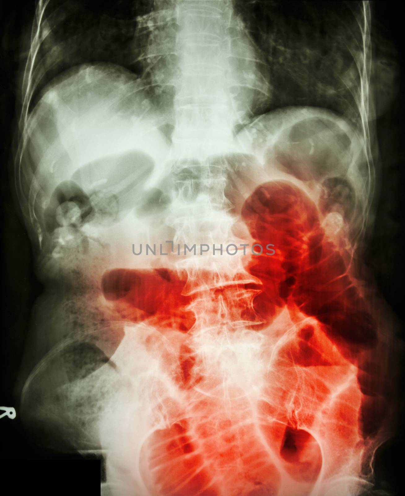 Small bowel obstruction. Film X-ray abdomen supine : show small bowel dilated due to small bowel obstruction by stockdevil