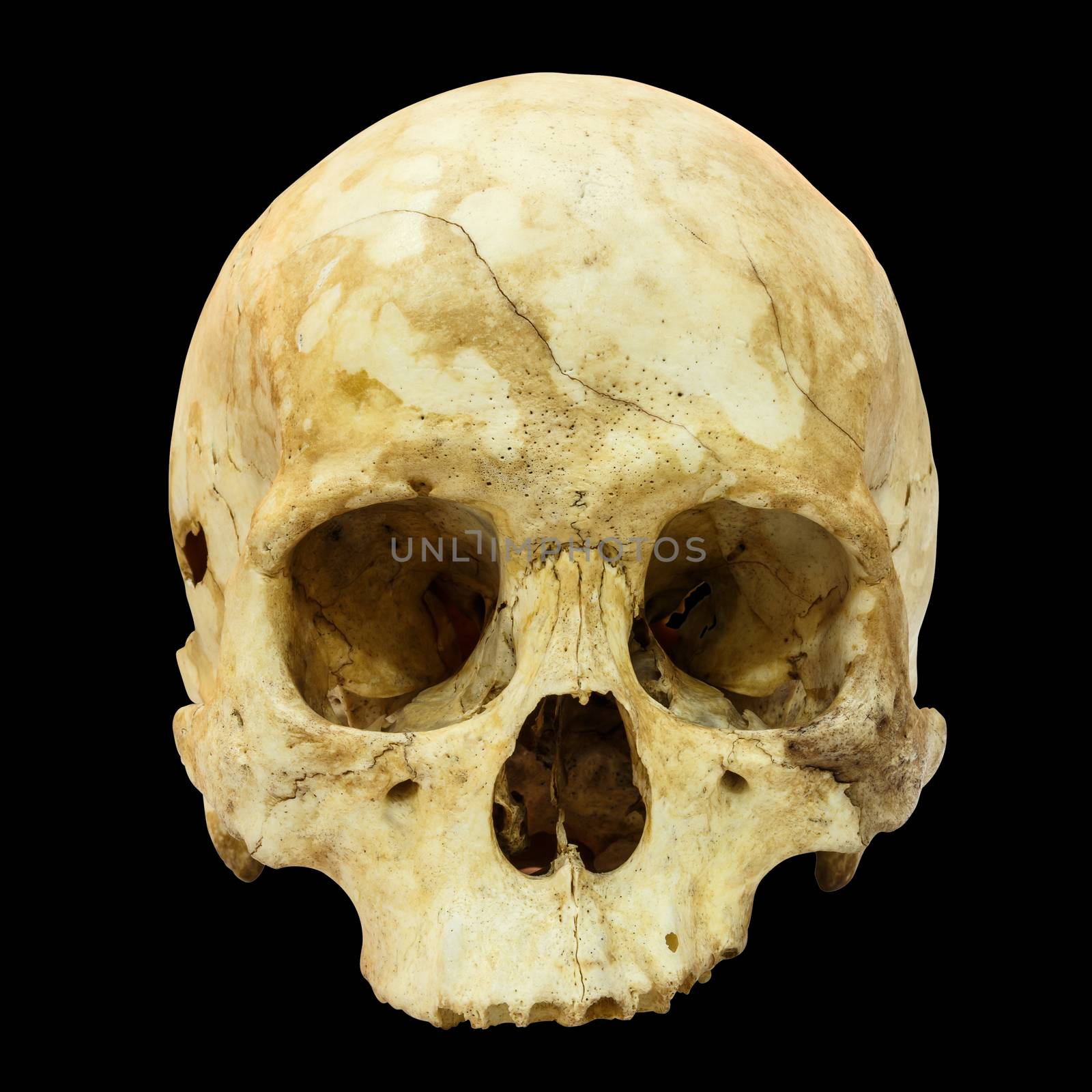 Human Skull Fracture (Mongoloid,Asian) on isolated background by stockdevil
