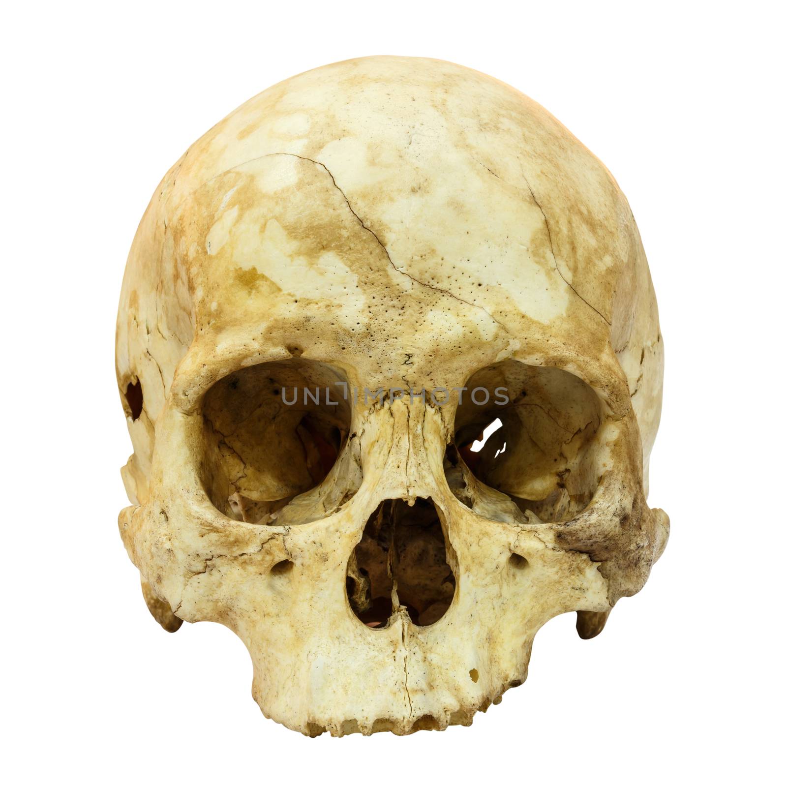 Human Skull Fracture (Mongoloid,Asian) on isolated background by stockdevil