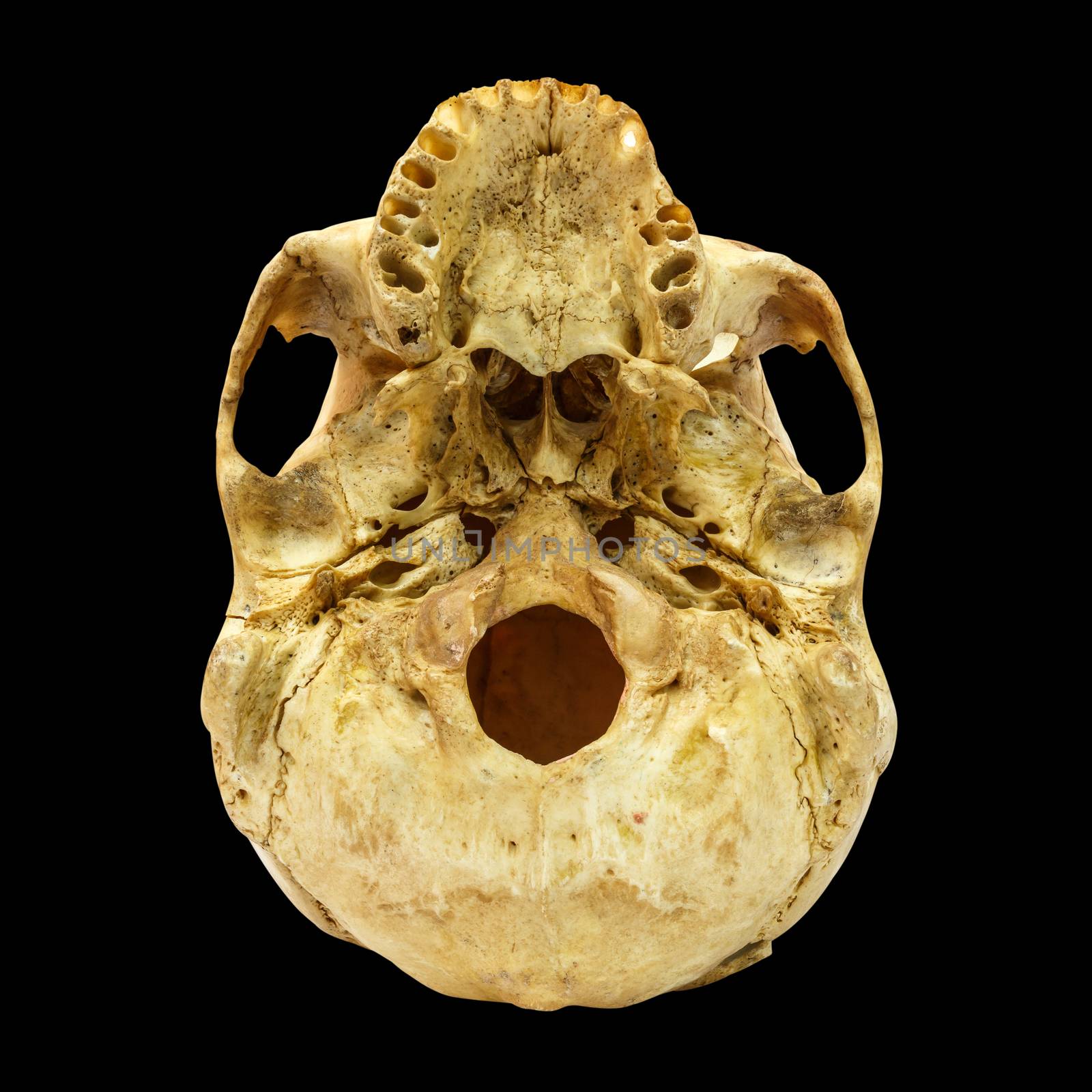 Human Skull Fracture(beneath) (Mongoloid,Asian) on isolated background