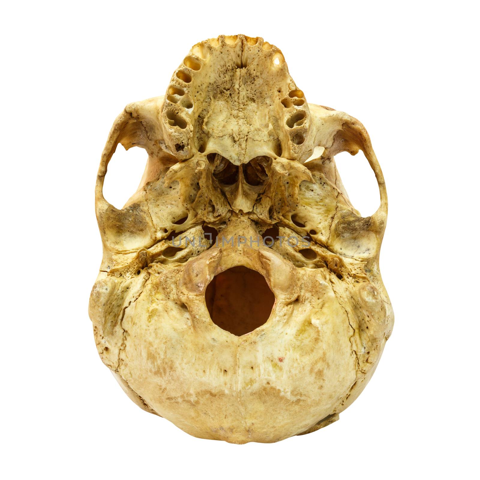 Human Skull Fracture(beneath) (Mongoloid,Asian) on isolated background