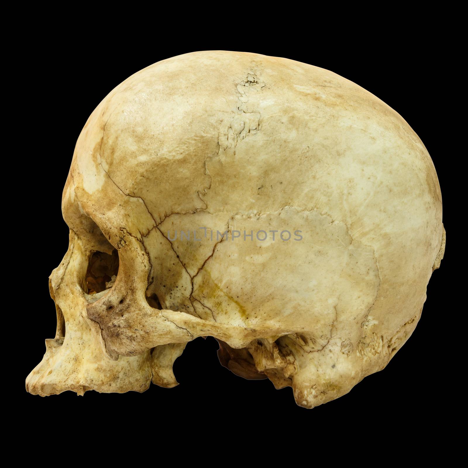 Human Skull Fracture (side) (Mongoloid,Asian) on isolated background by stockdevil