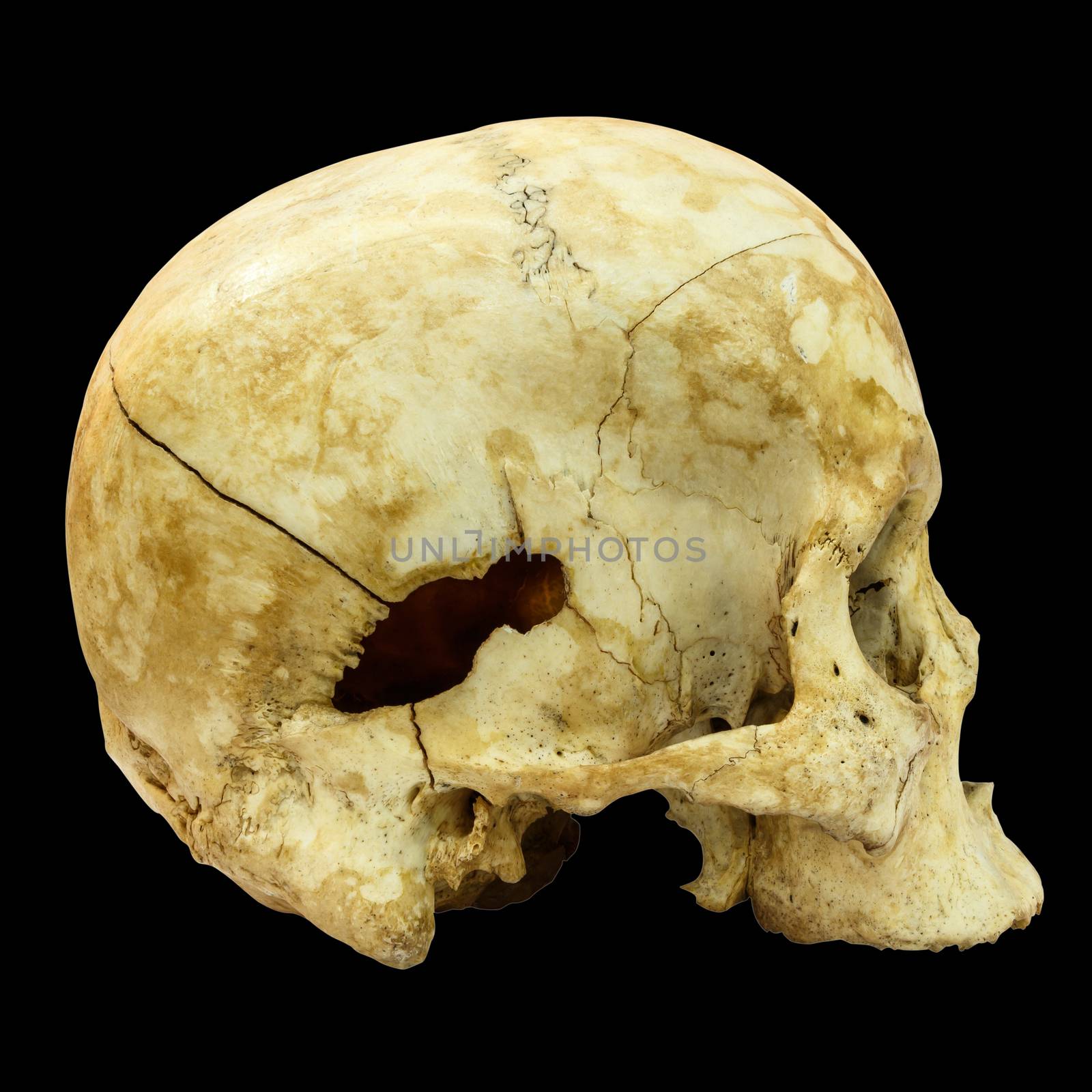 Human Skull Fracture(side) (Mongoloid,Asian) on isolated backgro by stockdevil