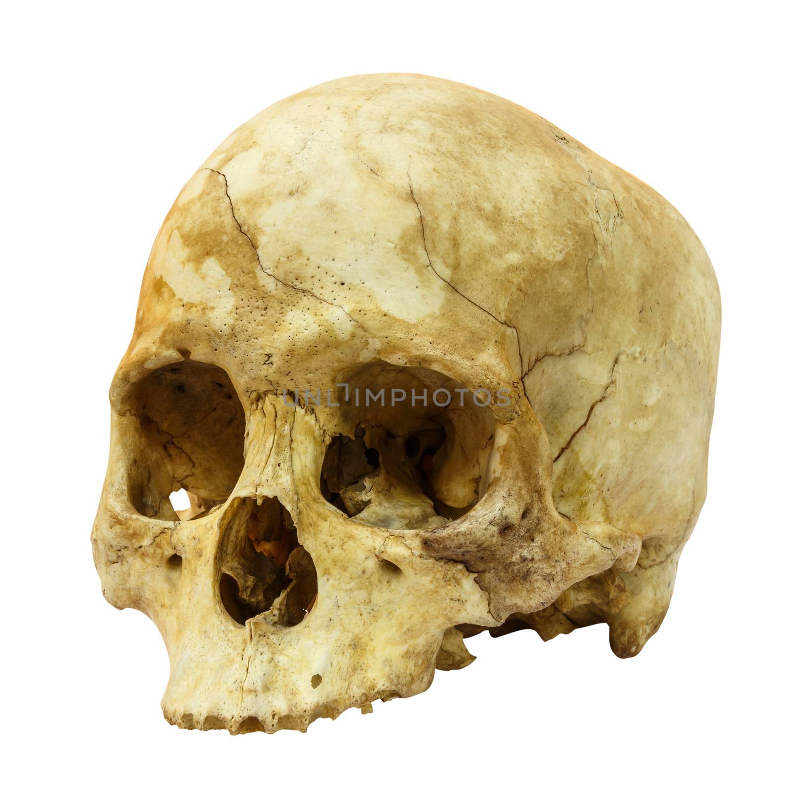 Human Skull Fracture(side) (Mongoloid,Asian) on isolated background
