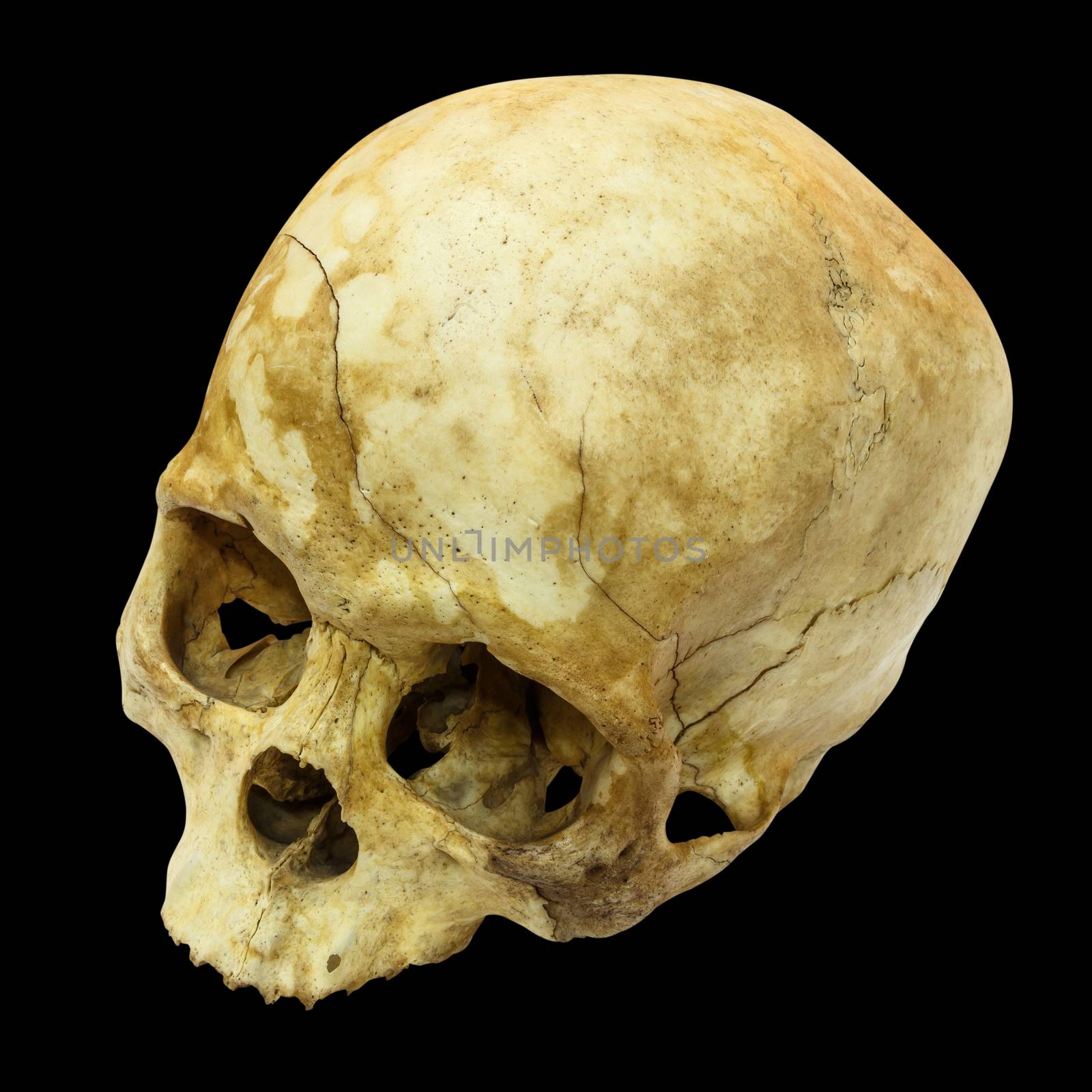 Human Skull Fracture(top side,apex)(Mongoloid,Asian) on isolated background