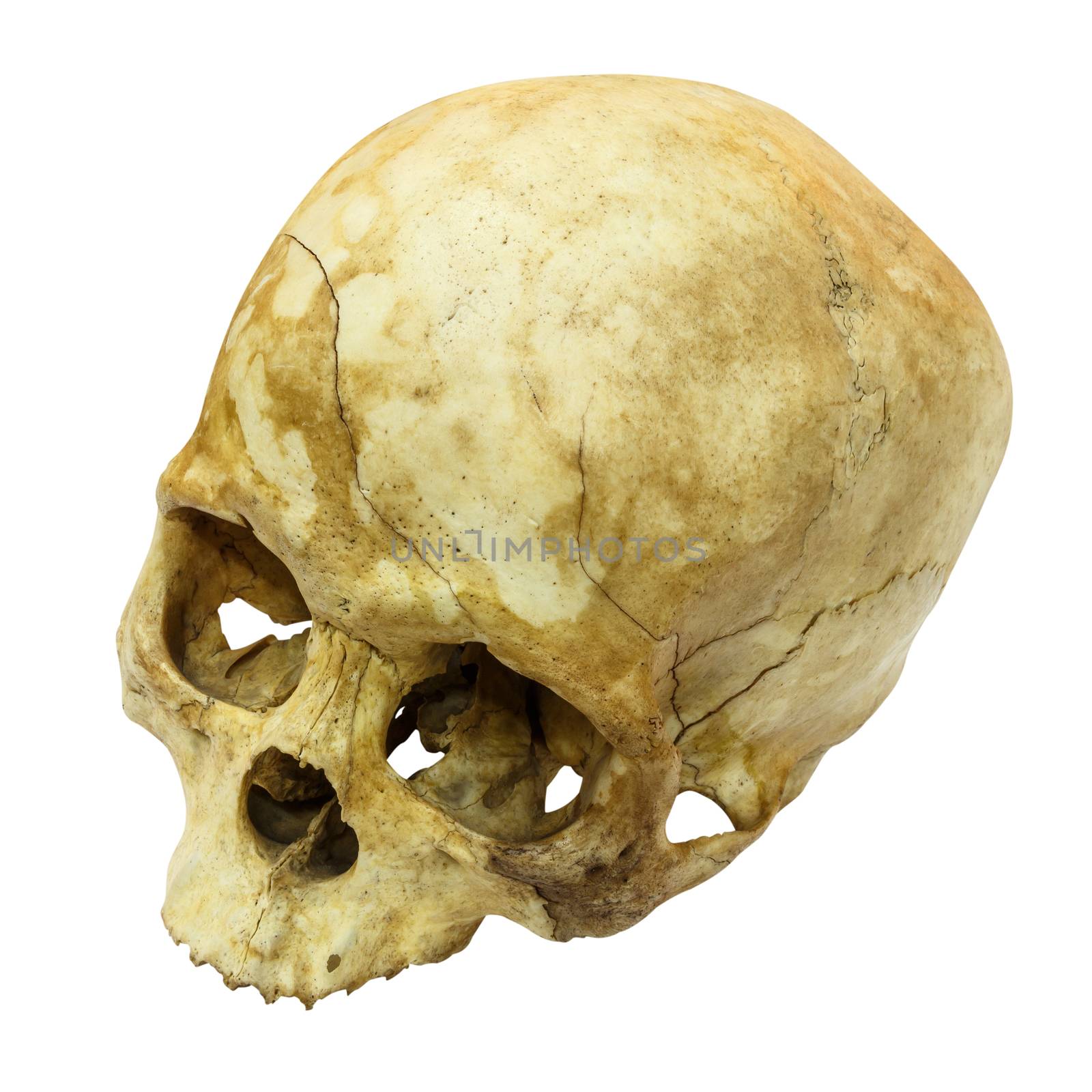 Human Skull Fracture(top side,apex)(Mongoloid,Asian) on isolated by stockdevil