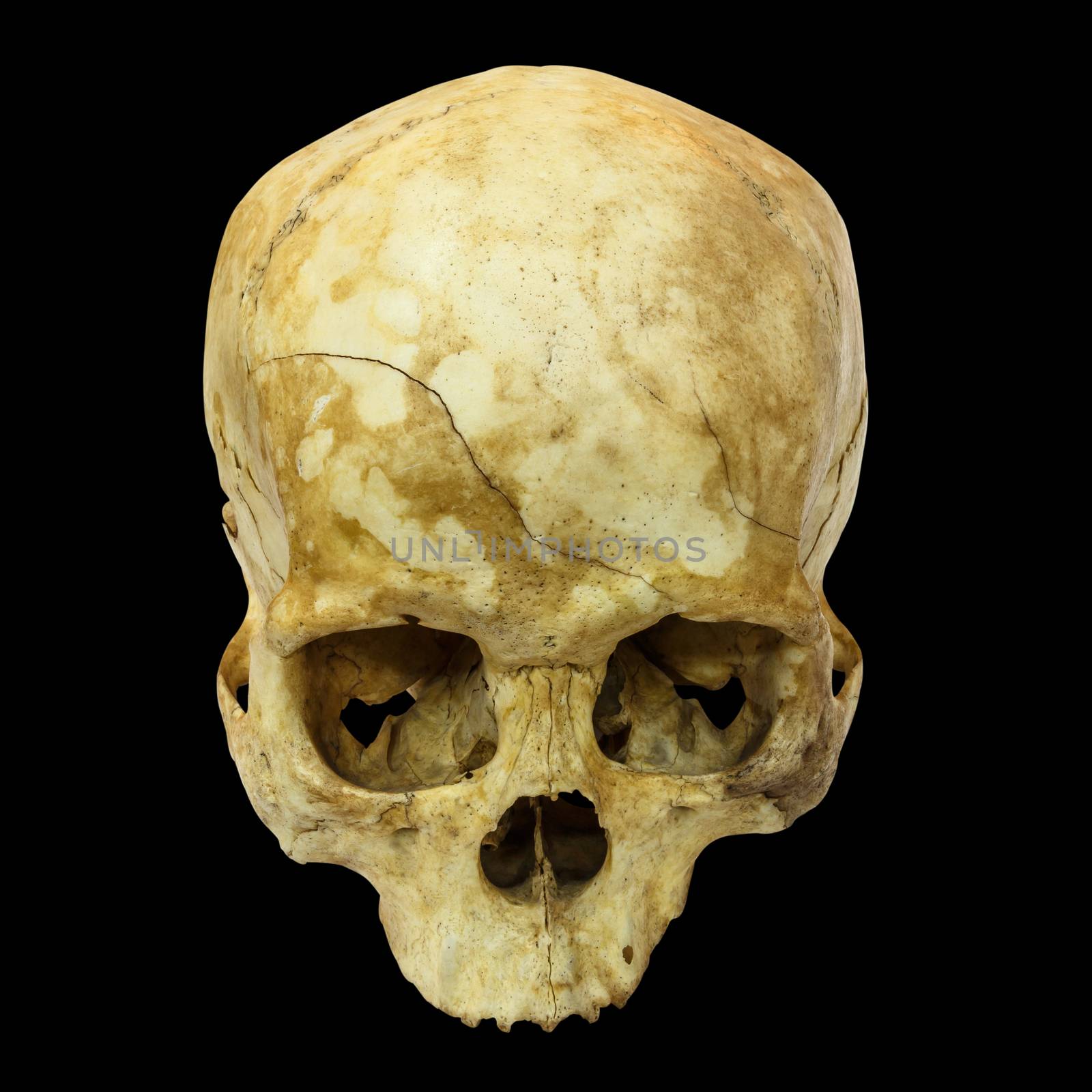 Human Skull Fracture(top side,apex)(Mongoloid,Asian) on isolated background