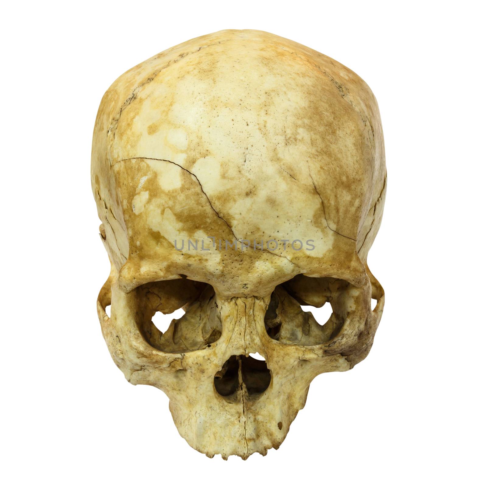 Human Skull Fracture(top side,apex)(Mongoloid,Asian) on isolated by stockdevil