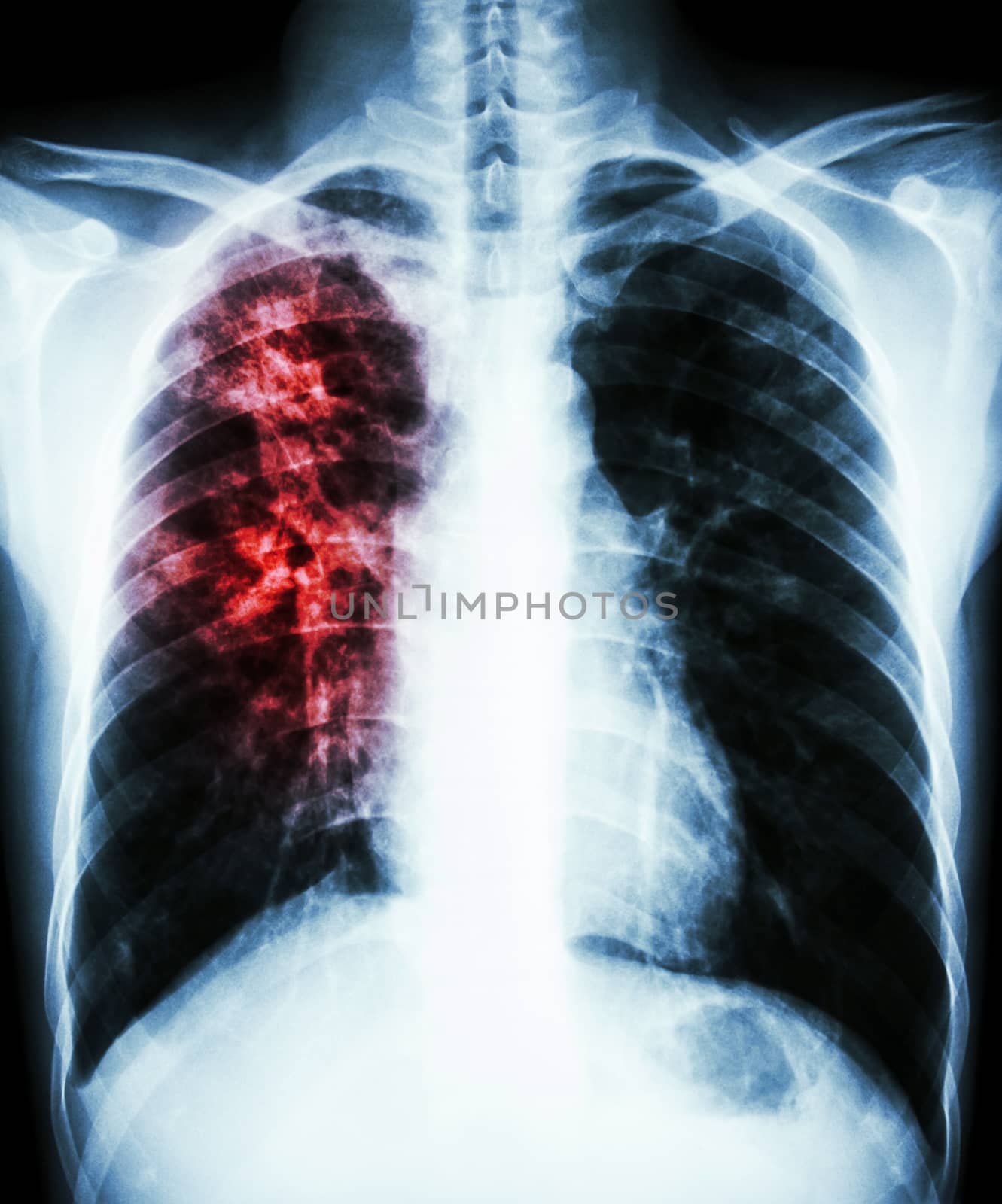 film chest x-ray PA upright : show interstitial infiltration at right lung due to mycobacterium tuberculosis infection (Pulmonary tuberculosis)